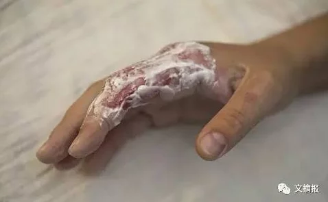 啊啊啊好痛小明在家尝试做蛋糕，结果烫到了手