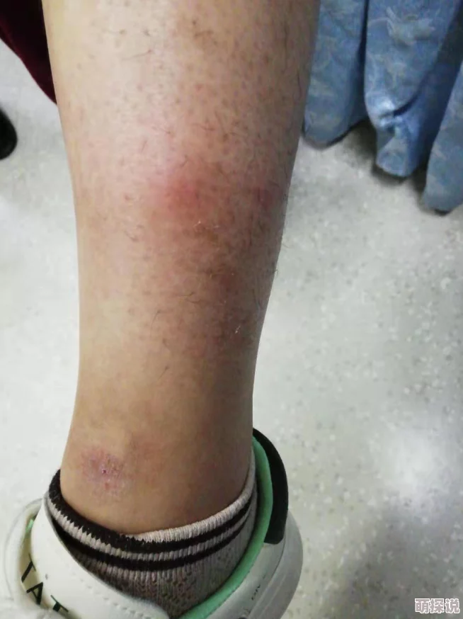 淑芬俩腿间又痒了医生说是过敏开了药膏并嘱咐她注意卫生 淑芬俩腿间又痒了医生说是过敏开了药膏并嘱咐她注意卫生