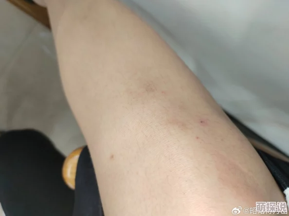 淑芬俩腿间又痒了医生说是过敏开了药膏并嘱咐她注意卫生 淑芬俩腿间又痒了医生说是过敏开了药膏并嘱咐她注意卫生