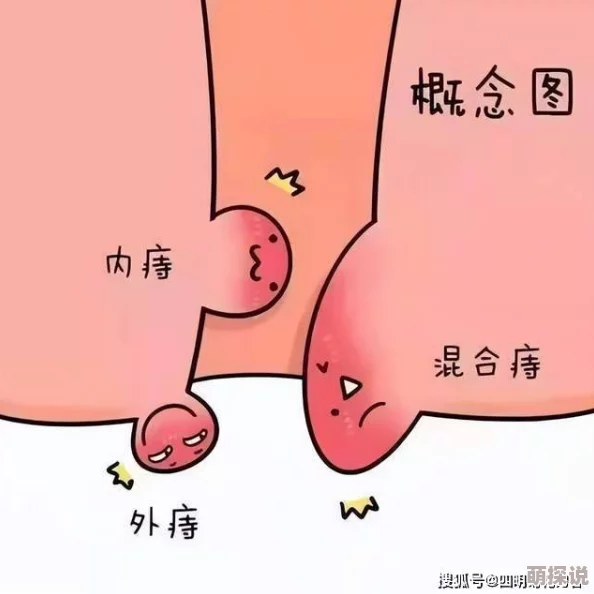 红肿的肛门一张一缩2025元宇宙医疗大会聚焦AI辅助痔疮诊断技术